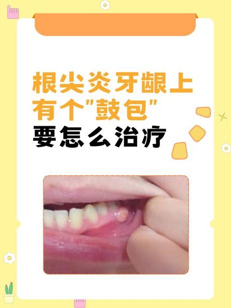 牙龈发炎怎么办？