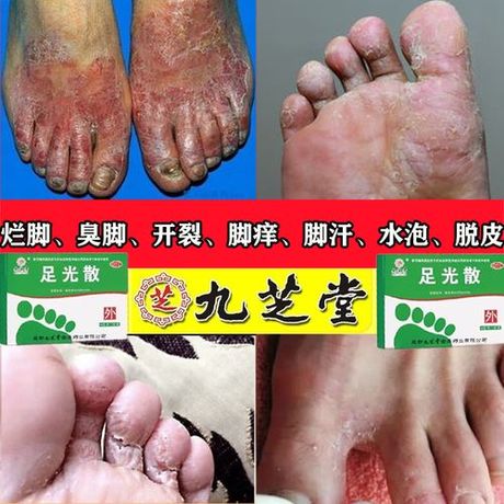 足光散治脚气怎么样