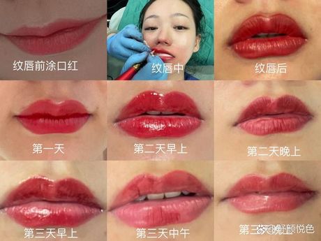痂掉后红色肉多久消失：皮肤愈合的奥秘