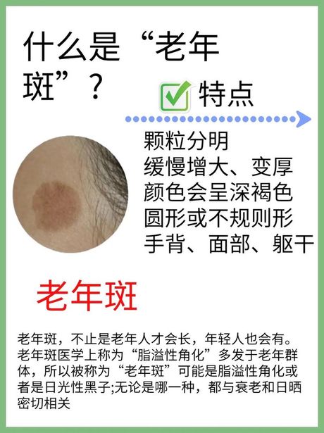老人斑的成因与去除方法