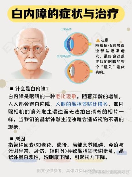 白内障的形成原因：深入解析常见眼科疾病