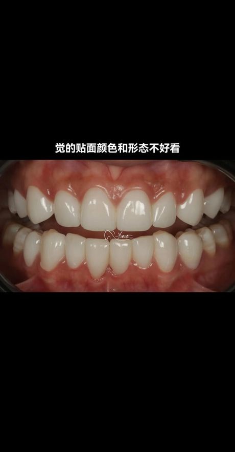 牙齿贴片多少钱一颗？