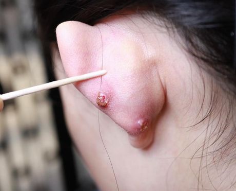 耳洞发炎怎么办？