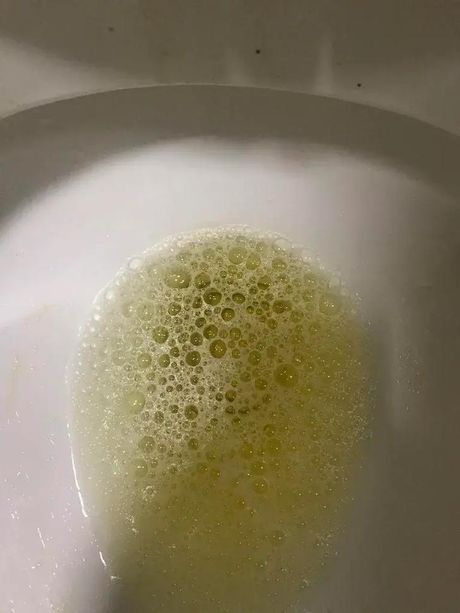 尿中有泡沫是怎么回事