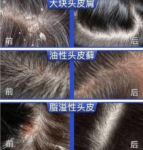 头皮痒和头皮屑多：原因解析