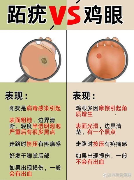 鸡眼：成因、治疗与预防