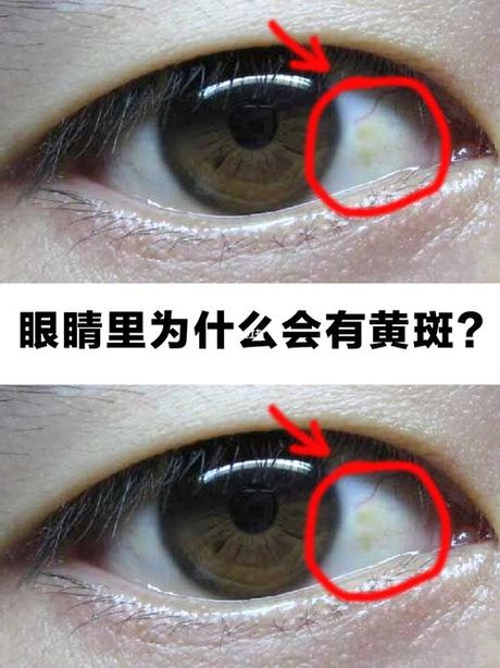 眼白发黄是怎么回事？