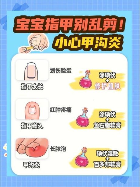 甲沟炎初期红肿的治疗方法