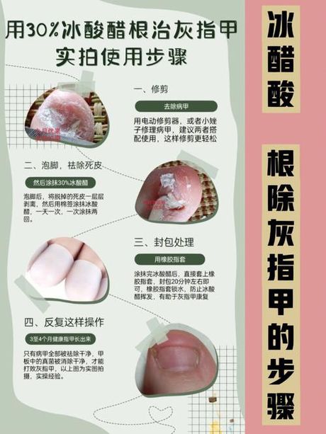 灰指甲的根除方法