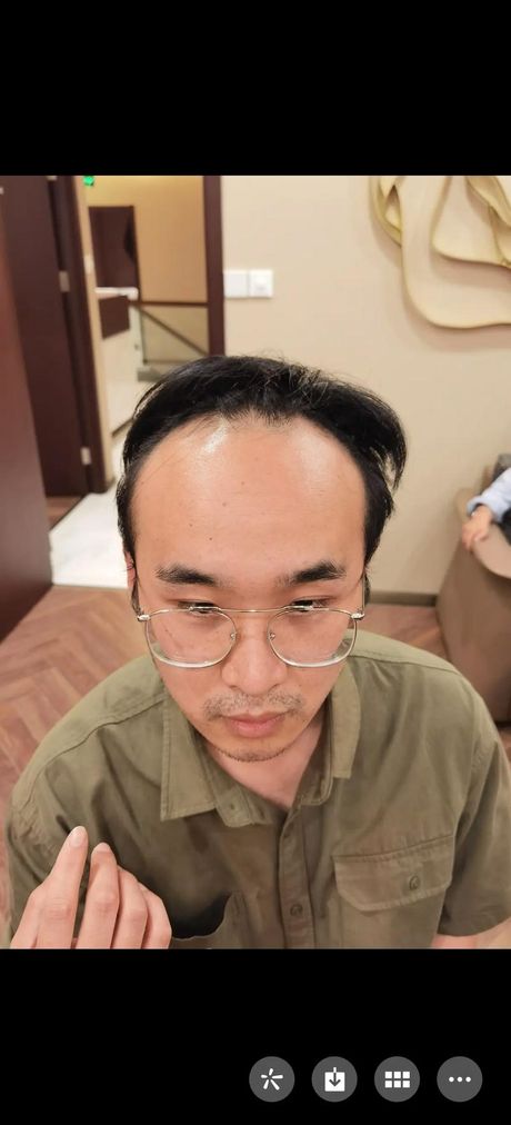 发际线太高了怎么办？