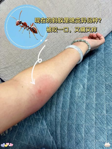被毒虫咬了肿胀怎么办？