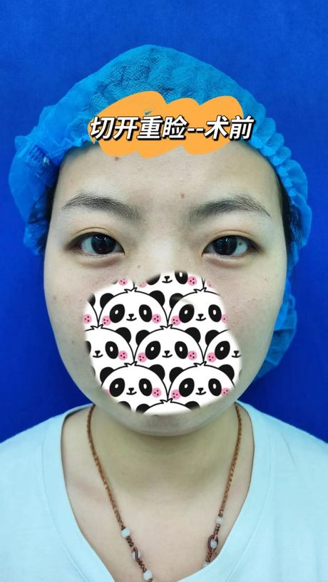开眼角手术的费用