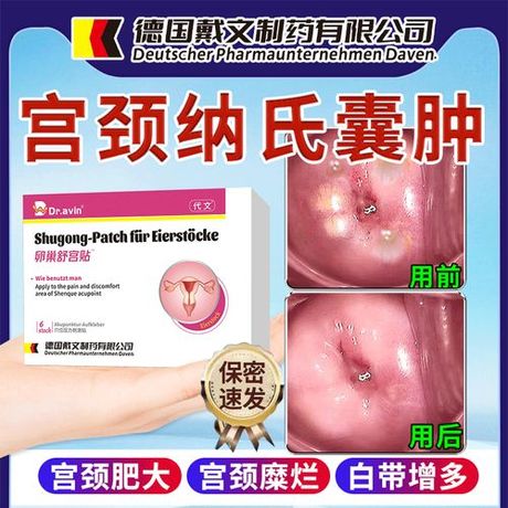 纳囊治疗全解析