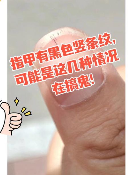 手指甲出现竖黑条纹是怎么回事