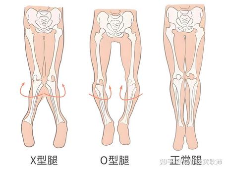 鸭子坐可以矫正腿型吗？