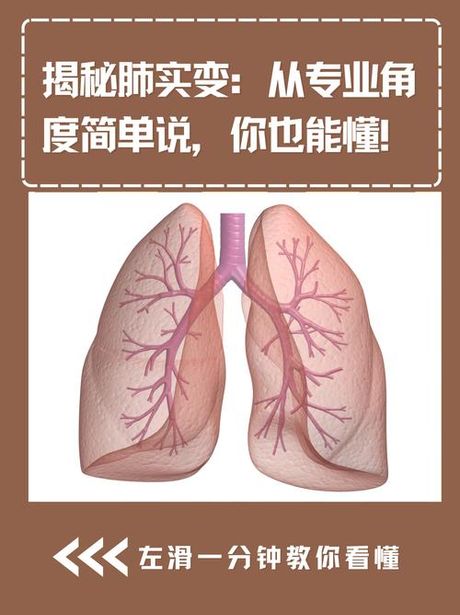 肺间质性改变：了解这一重要肺部现象