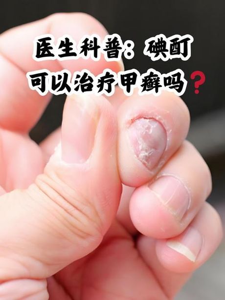 癣怎么读，“癣”字的读音及科普