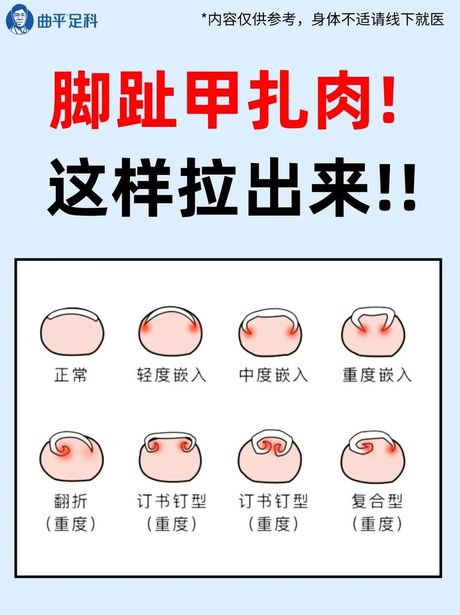 指甲长到肉里怎么软化：解决嵌甲问题的科学方法