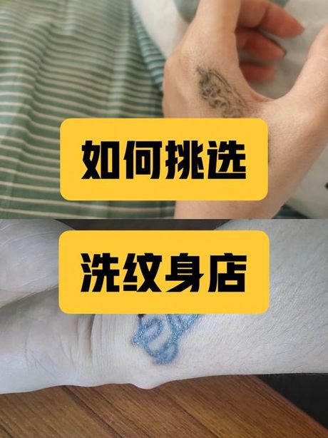 纹身去除：费用与选择