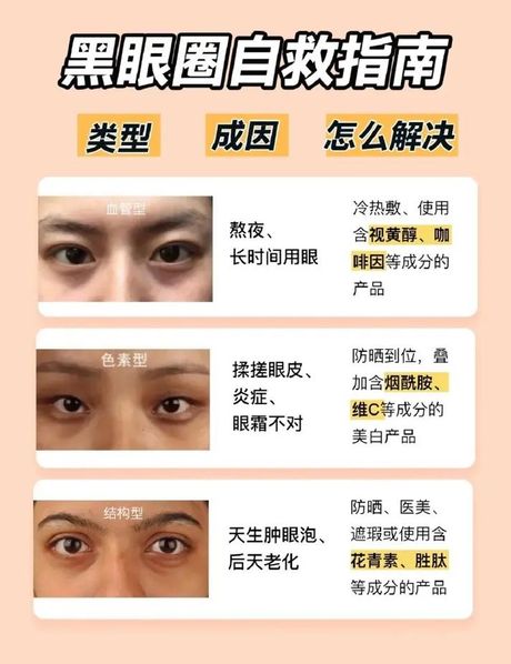 揭秘黑眼圈的形成原因