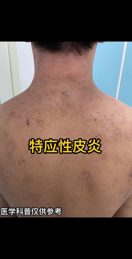 皮炎严重了会怎么样