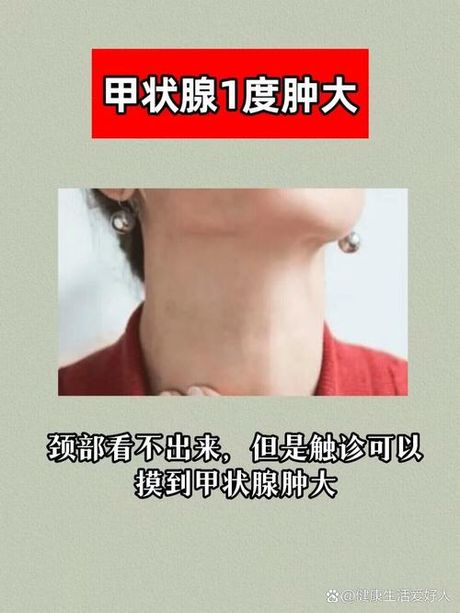 甲状腺肿大：原因及常见情况