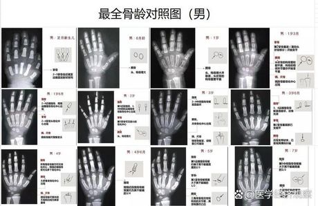 骨龄测试：费用与重要性
