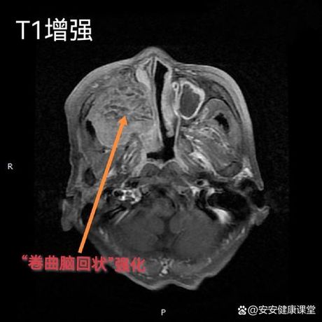 病灶：身体内的异常信号